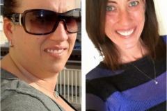 Bariatric Surgery - Before & After Weight Loss - Lap Band