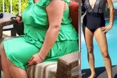 Bariatric Surgery - Before & After Weight Loss - Lap Band