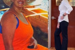 Bariatric Surgery - Before & After Weight Loss - Lap Band