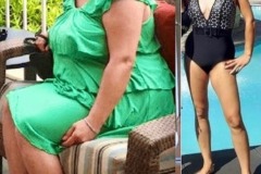 Bariatric Surgery - Before & After Weight Loss - Lap Band