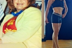 Bariatric Surgery - Before & After Weight Loss - Lap Band