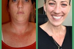Bariatric Surgery - Before & After Weight Loss - Lap Band