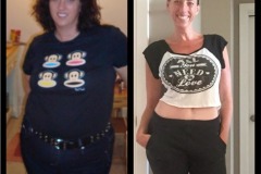 Bariatric Surgery - Before & After Weight Loss - Lap Band