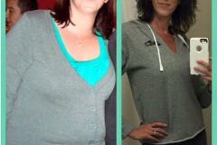 Bariatric Surgery - Before & After Weight Loss - Lap Band