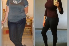 Bariatric Surgery - Before & After Weight Loss - Lap Band