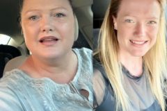 Bariatric Surgery - Before & After Weight Loss - Lap Band