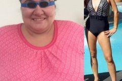 Bariatric Surgery - Before & After Weight Loss - Lap Band
