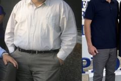 Bariatric Surgery - Before & After Weight Loss - Lap Band