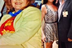 Bariatric Surgery - Before & After Weight Loss - Lap Band