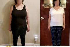 Bariatric Surgery - Before & After Weight Loss Surgery Photo - Gastric Band Sleeve Bypass Balloon
