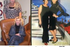 Bariatric Surgery - Before & After Weight Loss Surgery Photo - Gastric Band Sleeve Bypass Balloon
