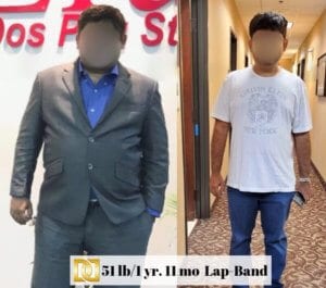 Bariatric-Surgery-Before-And-After-Lap-Band-Surgery-Results-Weight-Loss-Surgery-Center-Of-Los-Angeles-Beverly-Hills-Glendale-Rancho-Cucamonga