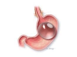Orbera Gastric Balloon for Weight Loss in Stomach