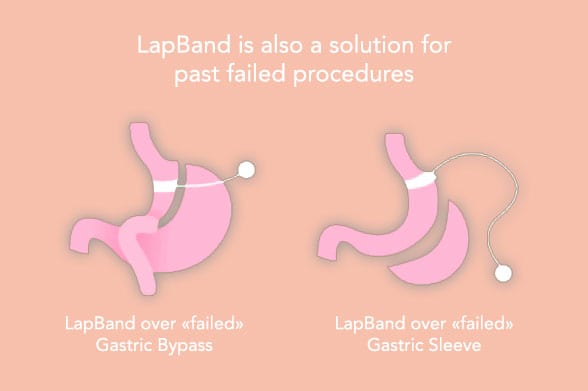 Lap-Band Fail Solution