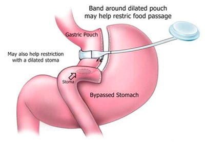 Gastric Band Surgery (LAP-Band): What It Is, Requirements & Procedure