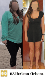 Orbera Gastric Balloon Weight Loss