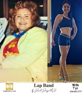 Sonia Cabrera Lap Band Patient Before and After comparison