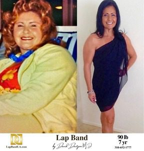 Sonia Cabrera LapBand Patient Before and After comparison