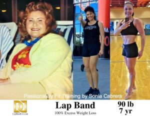 Sonia Cabrera Lap-Band surgery Patient Before and After comparison