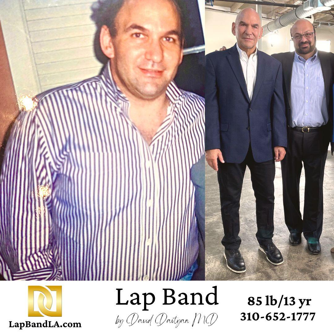 Jeff Weiss Lap-Band weight loss Surgery Before and after comparison
