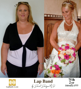 Stacy Lap Band surgery Before & After by Dr. Davtyan at The Weight Loss Surgery Center Of Los Angeles
