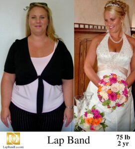 Stacey's Before & After Photo After 2 Years of Using The Lap-Band and Losing 75 lbs. of Excess Weight