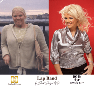 Tanya Lap Band surgery Before & After by Dr. Davtyan at The Weight Loss Surgery Center Of Los Angeles