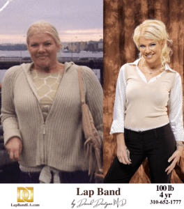 Tanya Lap-Band surgery before and after comparison