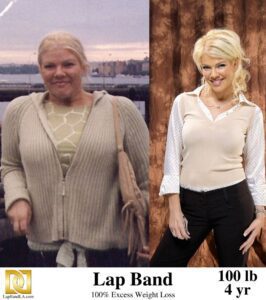 Stacey's Before & After Photo After 4 Years of Using The Lap-Band and Losing 133% of Excess Weight