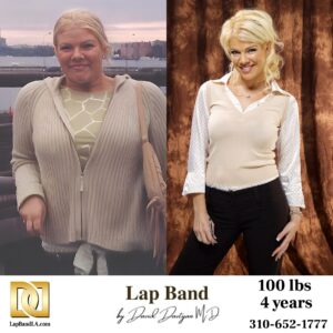 Tanya Bariatric Surgery before and after los angeles