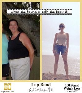 Banded Wendy Lap Band surgery Patient Before and After comparison