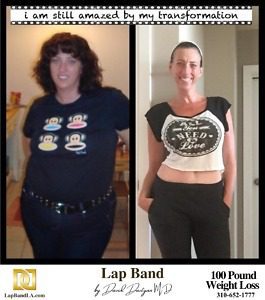 Banded Wendy Lap Band weight loss surgery Patient Before and After comparison