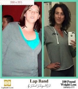 Lap Band surgery Before & After by Dr. Davtyan at The Weight Loss Surgery Center Of Los Angeles