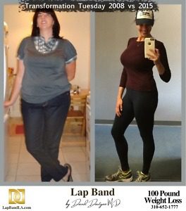 Banded Wendy weight loss surgery Before and After comparison