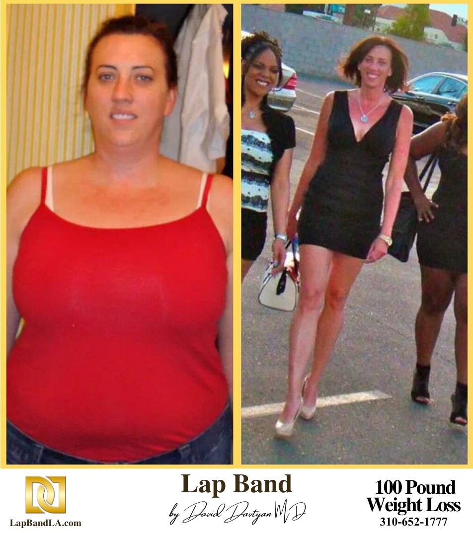 Banded Wendy Lap Band Patient Before and After comparison
