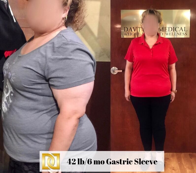 A-G-Gastric-Sleeve-Bariatric-Surgery-Before-And-After-At-Davtyan-Medical-Weight-Loss-And-Wellness-Beverly-Hills-Rancho-Cucamonga