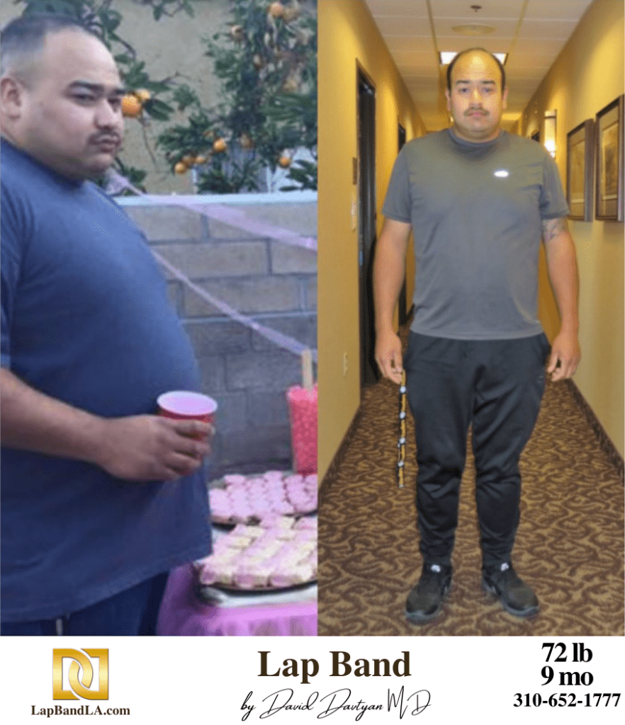 Before & After Lap Band Surgery | Patient Testimonials 