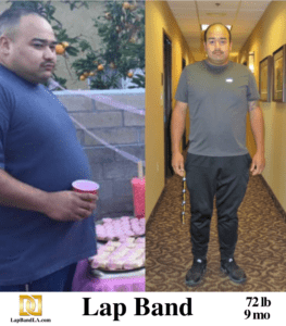 weight loss surgery before and after