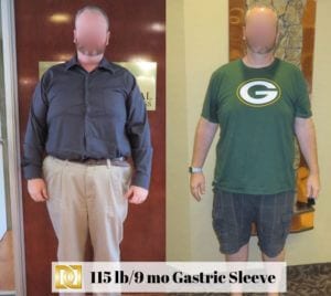 Bariatric-Surgery-Before-And-After-Gastric-Sleeve-At-Davtyan-Medical-Weight-Loss-And-Wellness-LA-Rancho-Cucamonga-Glendale-Beverly-Hills