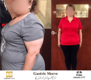 Gastric Sleeve surgery Before & After by Dr. Davtyan at The Weight Loss Surgery Center Of Los Angeles