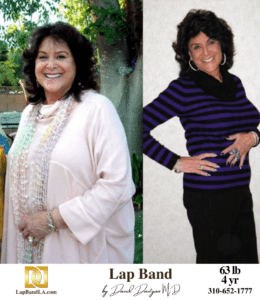 Candace Lap Band surgery Before & After by Dr. Davtyan at The Weight Loss Surgery Center Of Los Angeles