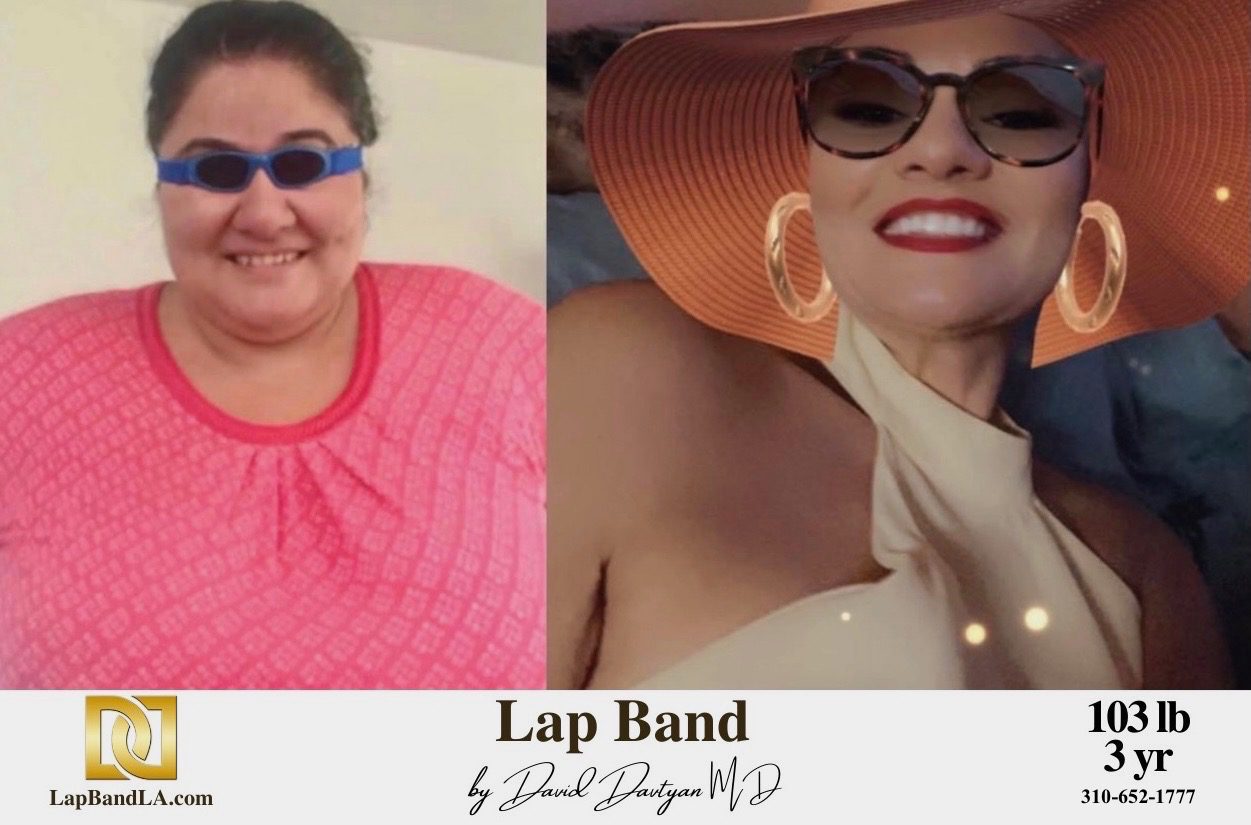 Dzovag Bariatric Surgery before and after los angeles weight loss surgery rancho cucamonga before and after