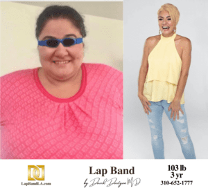 weight loss surgery in Los Angeles before and after picture
