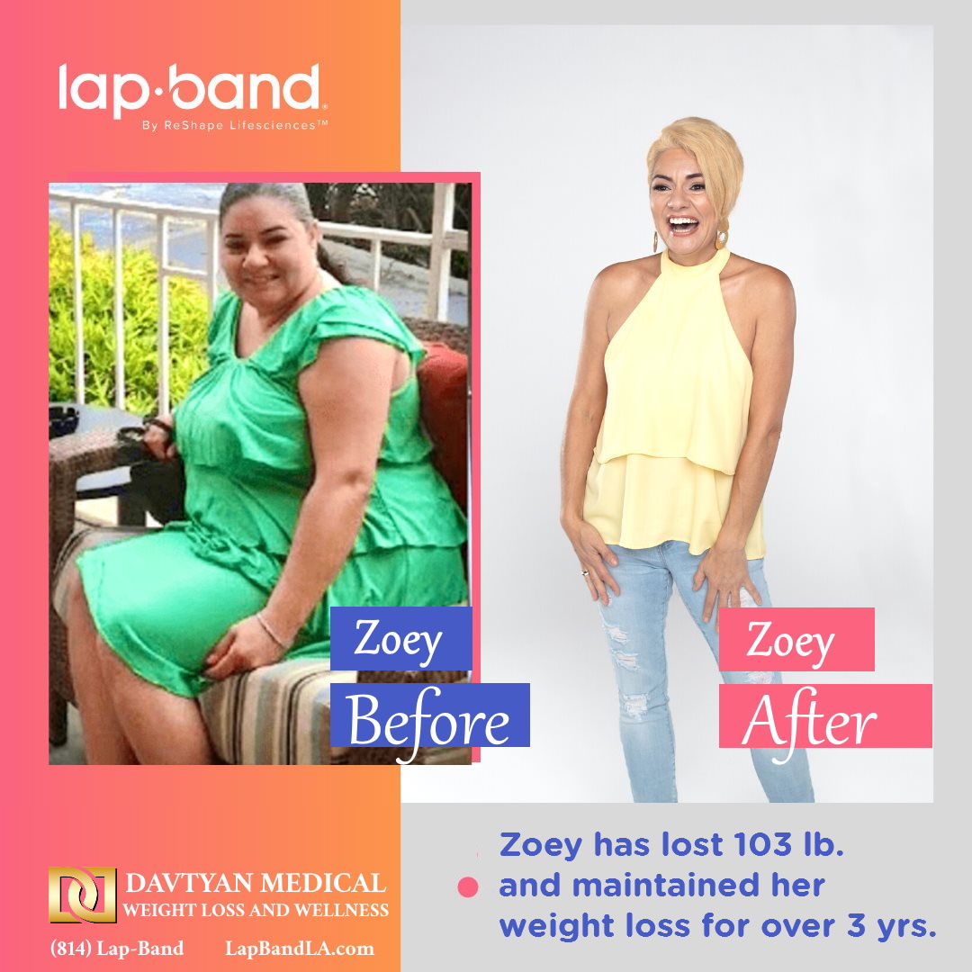 Lap band bariatric surgery patient who lost 103 lbs with Dr. Davtyan in Los Angeles