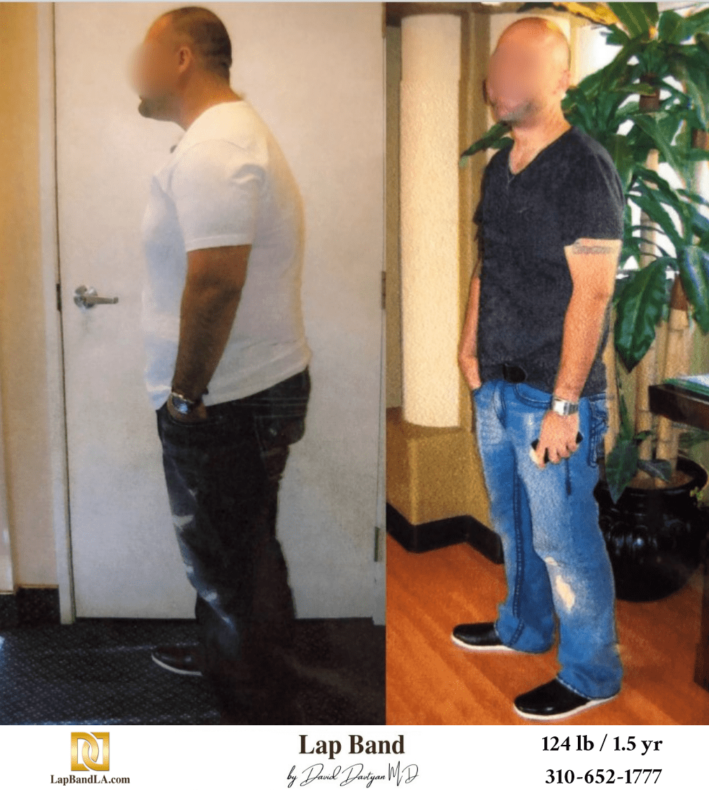 D.A. Bariatric Surgery before and after los angeles