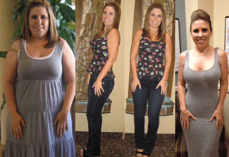 Elizabeth Didford Bariatric Surgery Before And After Los Angeles