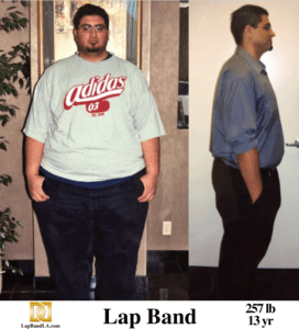 Nick Lap Band surgery Before & After by Dr. Davtyan at The Weight Loss Surgery Center Of Los Angeles