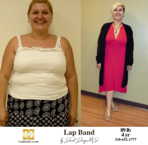 Lap Band Surgery before and after of Salbi
