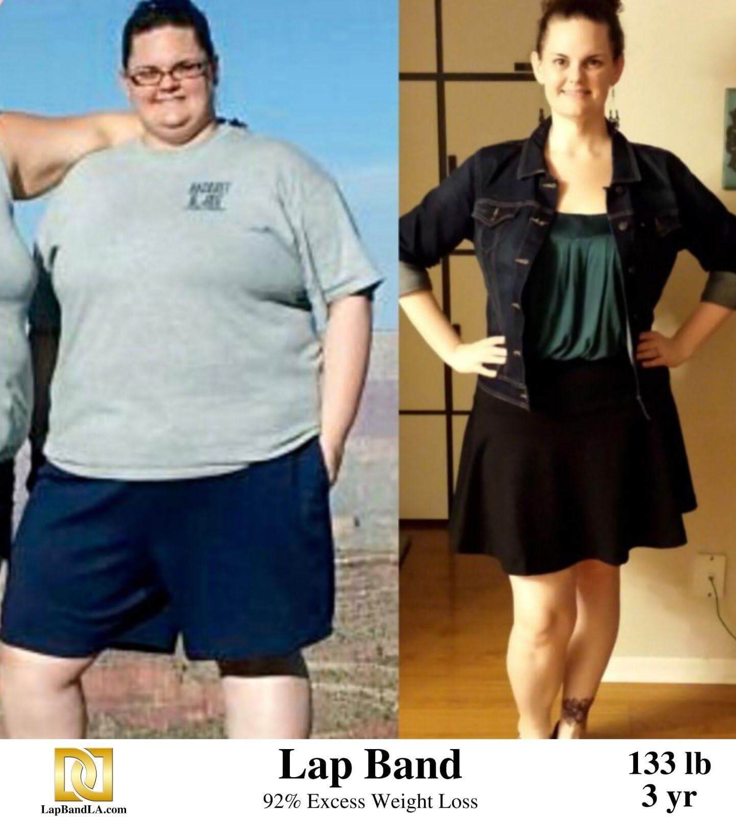 Lap Band Surgery Before And After Results Los Angeles Lap Band before and after 133 pound weight loss in 3 years