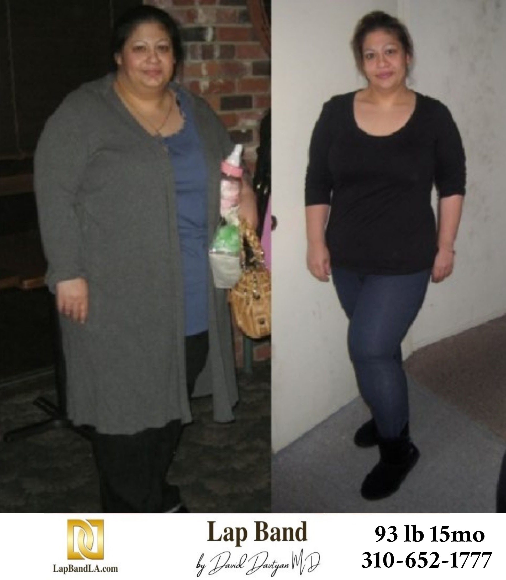 Anita S. Bariatric Surgery before and after los angeles